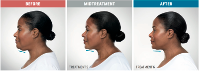 Elevation Med Spa Kybella Before and After 2 woman had treatments on her chin area