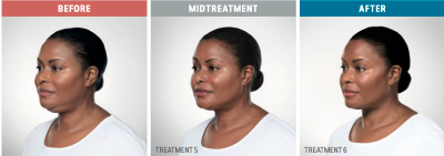 Elevation Med Spa Kybella Before and After 2 showing three photos of woman before during and after facial treatments