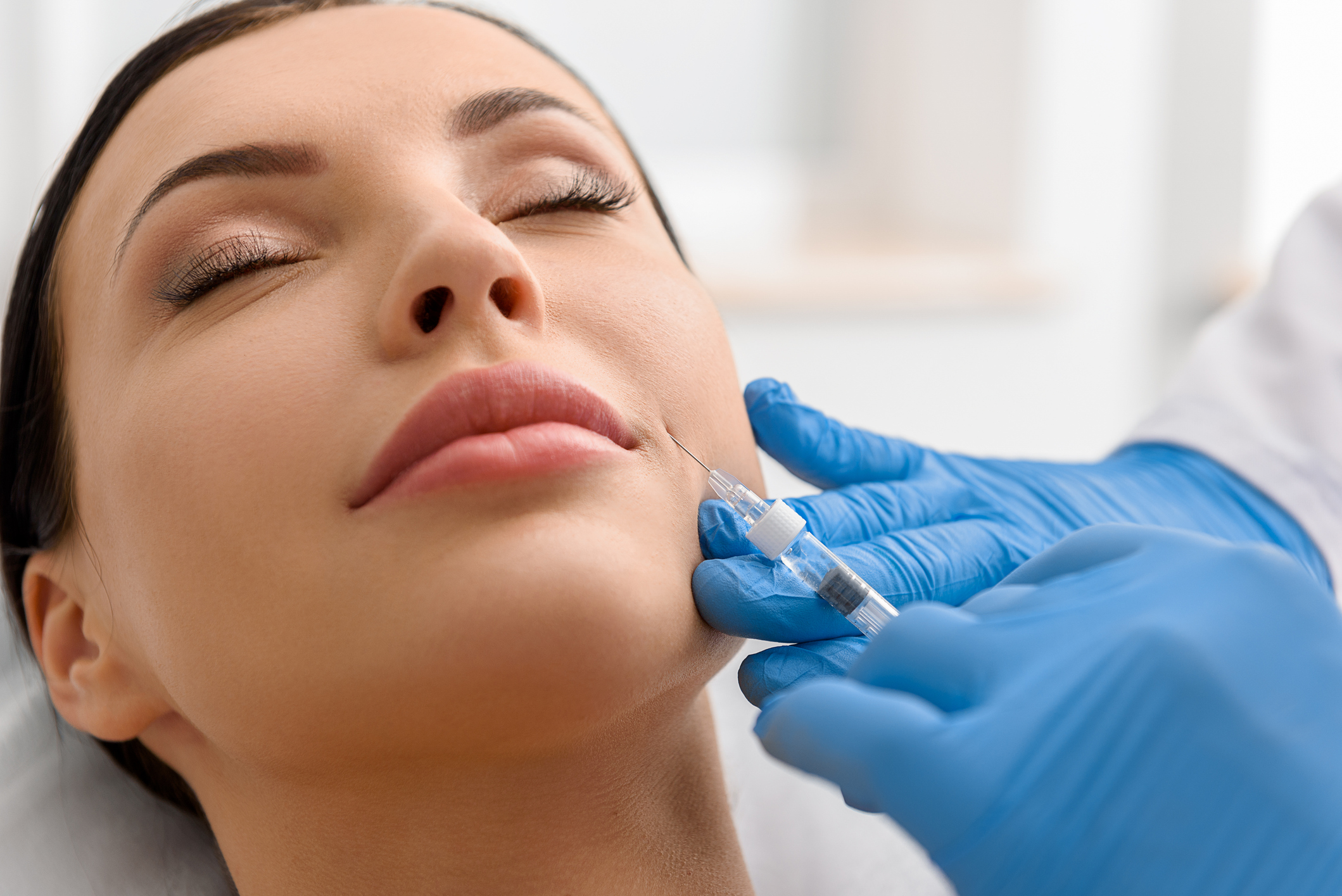 Dermal Filler: Nasolabial Folds