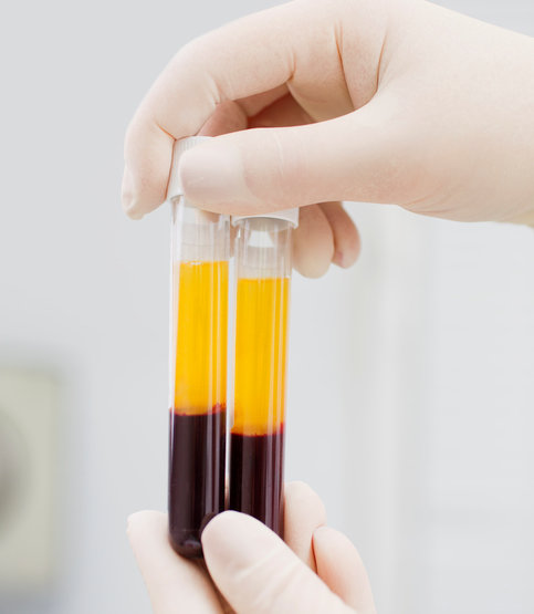 Elevation Med Spa Lone Tree Colorado - PRP Injections get results photo of injection vials
