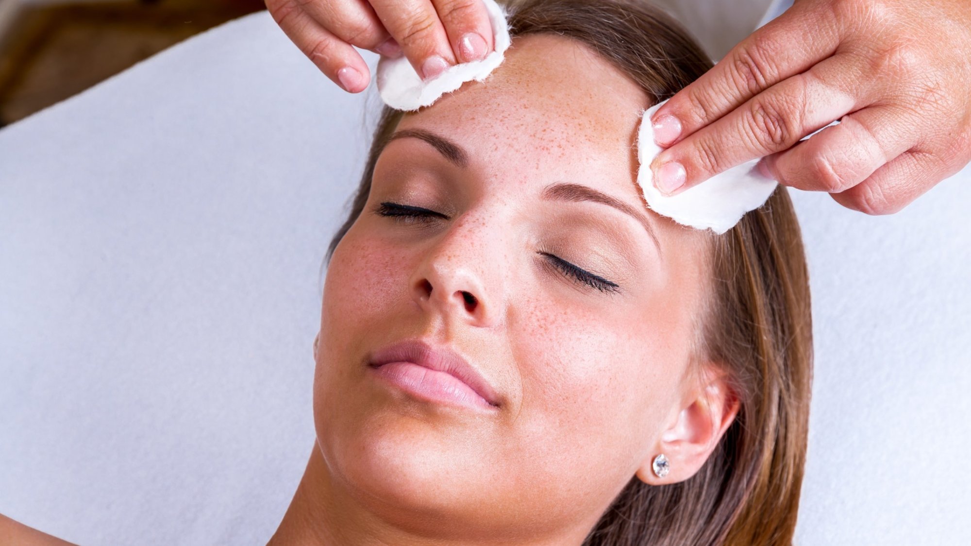 Chemical Peel
