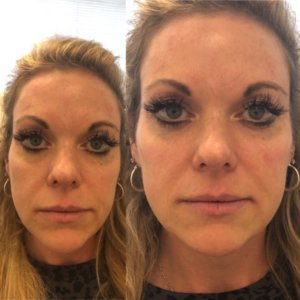 Cheek Filler