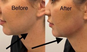 Jaw Line Filler