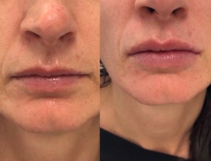 Lip Filler