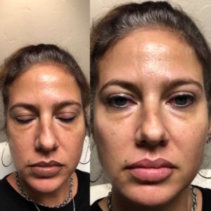 Lip and Cheek Filler