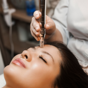 Microneedling